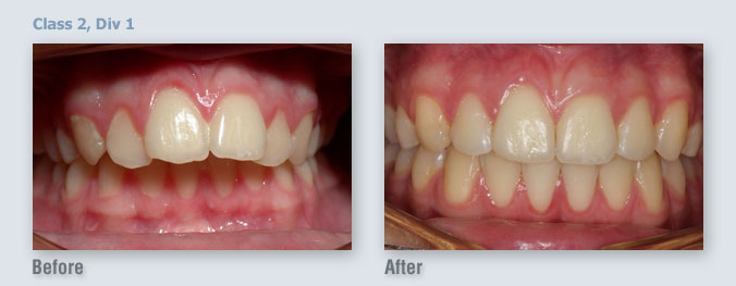 ortho_before-after11_1333508116