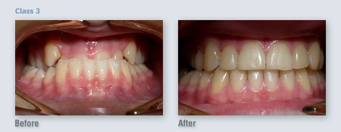 ortho_before-after13_1333508119